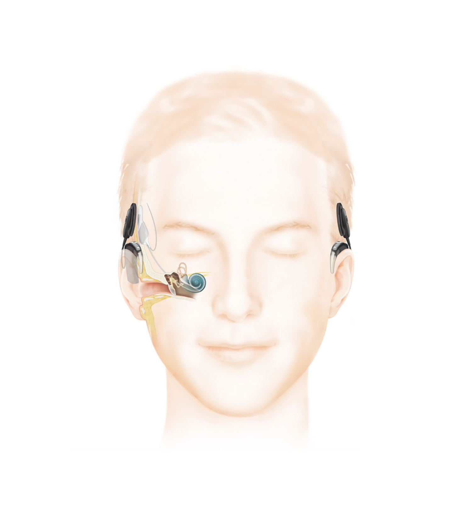 A diagram showing how a cochlear implant is inserted